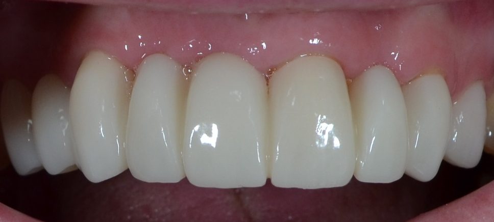 After dental bridges treatment — case 1