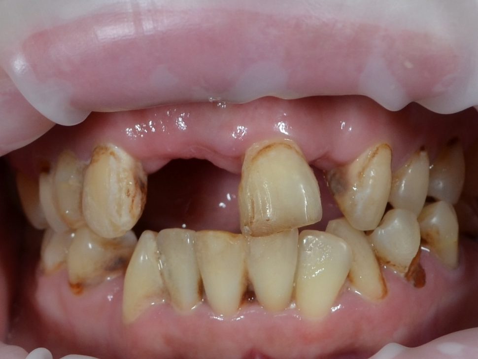 Before dental bridges treatment — case 1