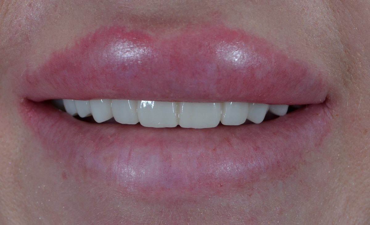 After dental bridges treatment — case 2