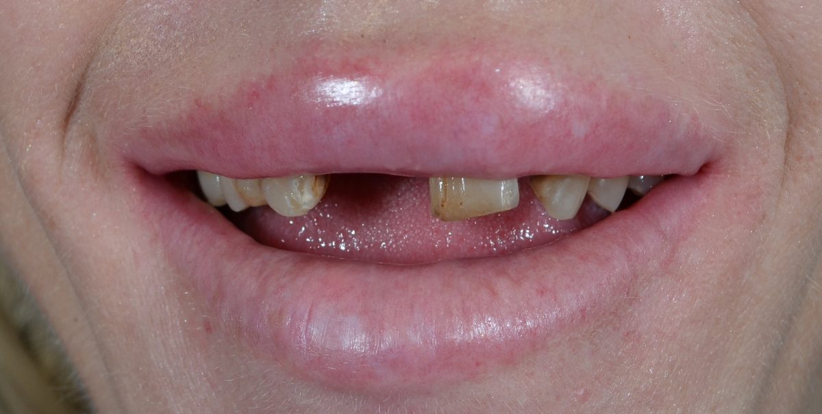 Before dental bridges treatment — case 2