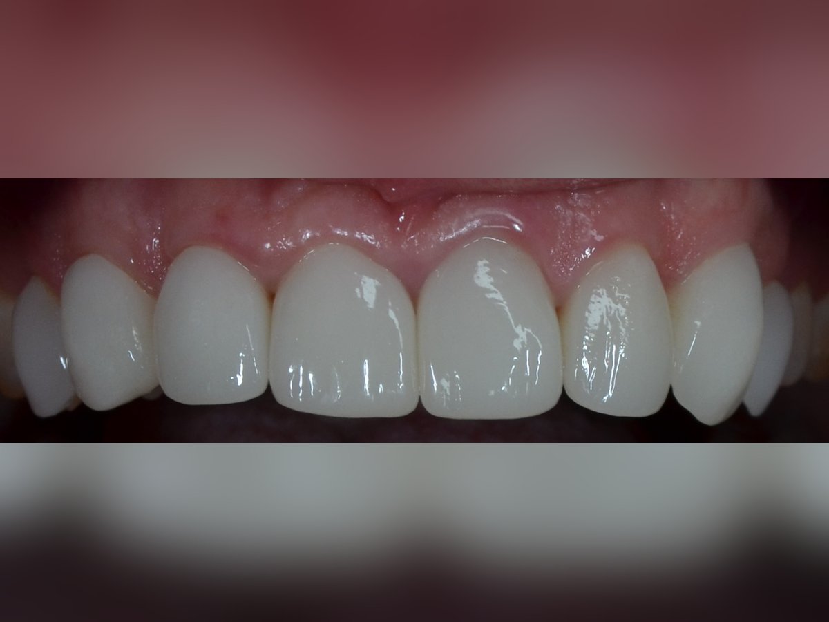 After same day veneers treatment — case 1