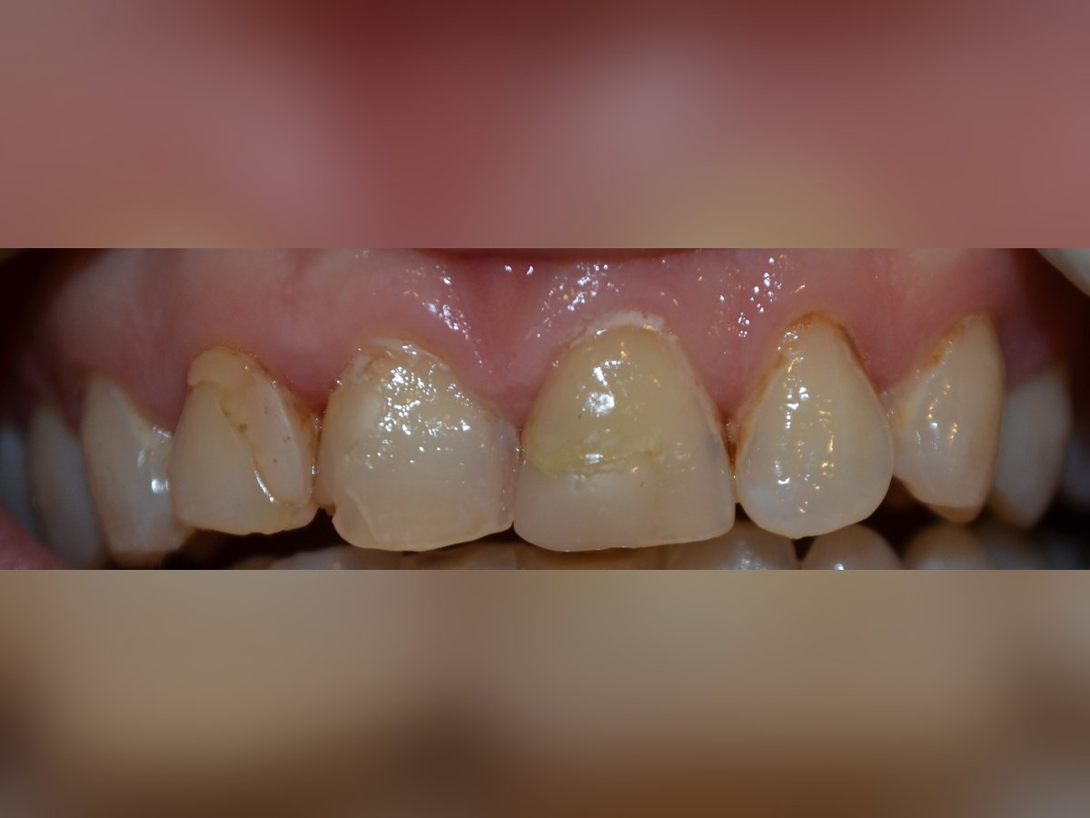 Before same day veneers treatment — case 1