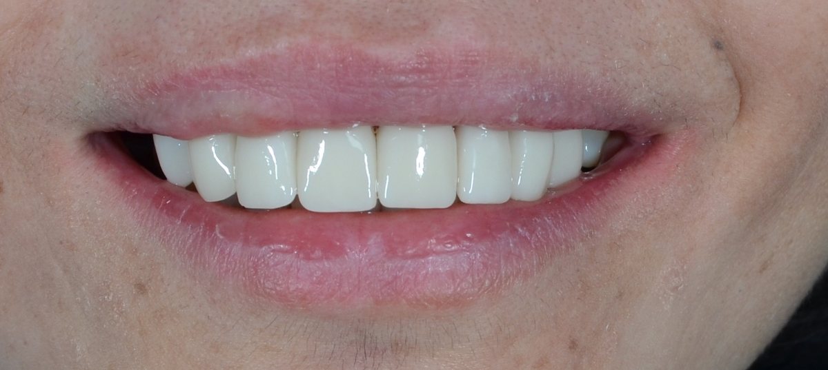 After same day veneers treatment — case 8