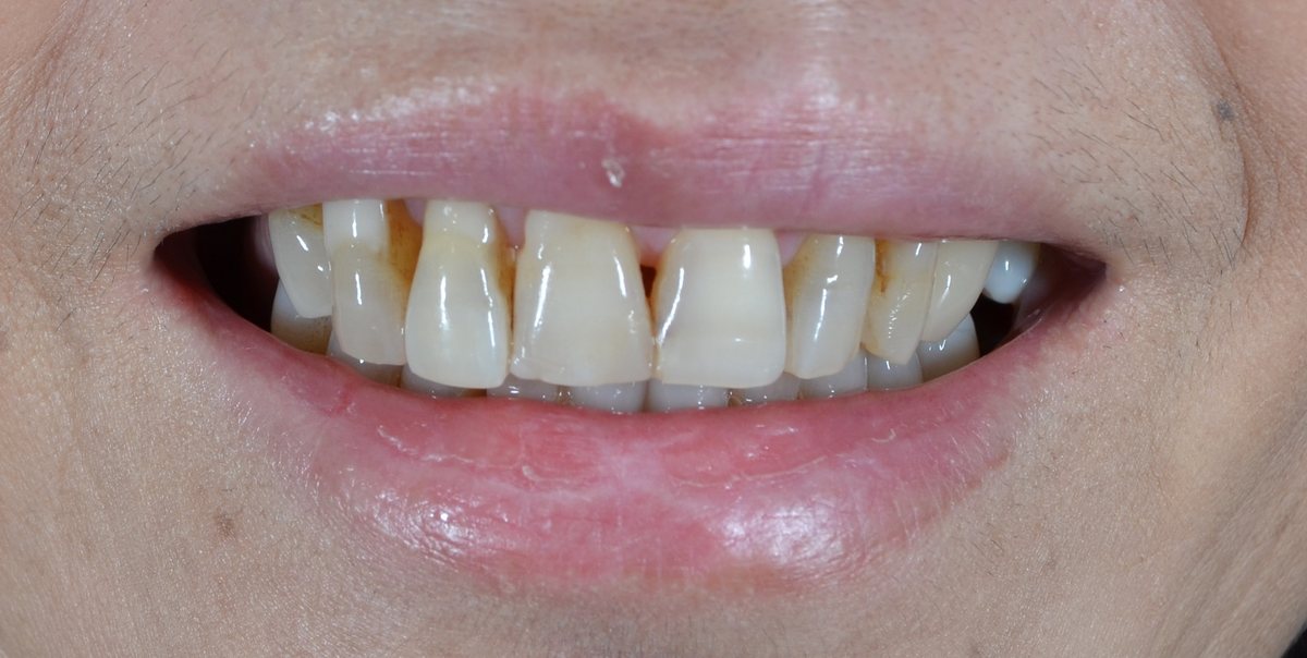 Before same day veneers treatment — case 8
